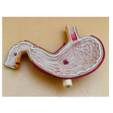 Model Of Stomach Showing Ulcer.