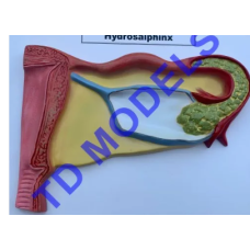 Hydrosalpinx Pathology Model