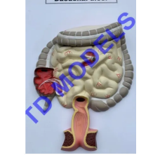 Duodenal Ulcer Pathology Model