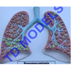 Pneumoniconiosis Model