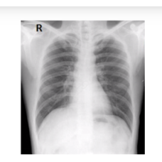 X-RAY CHEST PA VIEW